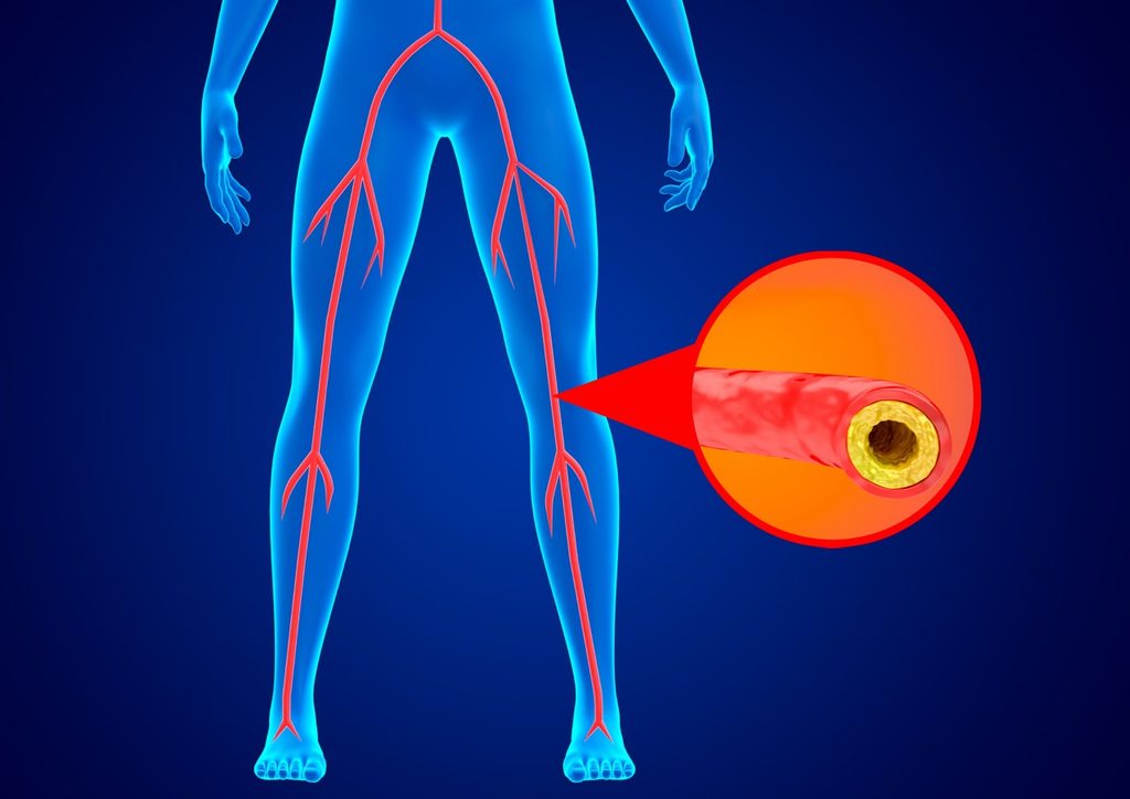 3D medical illustration showing arterial plaque accumulation and reduced blood flow in a lower limb affected by peripheral artery disease.
