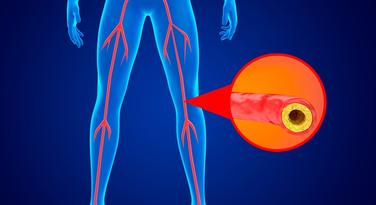 3D medical illustration showing arterial plaque accumulation and reduced blood flow in a lower limb affected by peripheral artery disease.