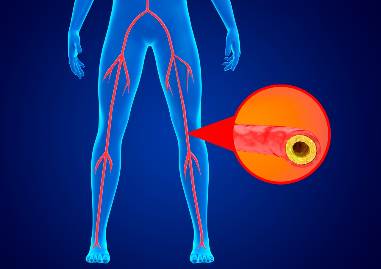 3D medical illustration showing arterial plaque accumulation and reduced blood flow in a lower limb affected by peripheral artery disease.