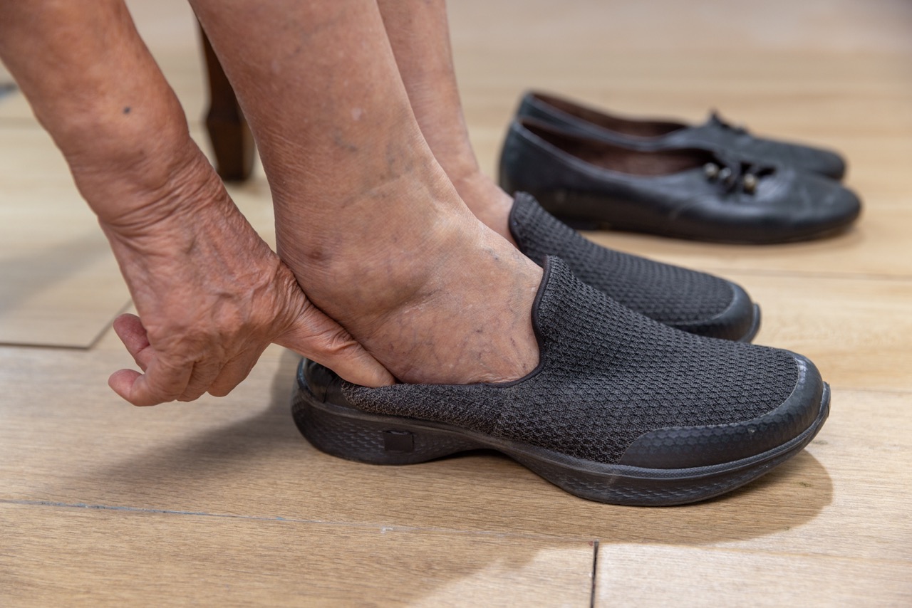 Pair of senior slip-on shoes next to a woman's lower legs and feet showing visible vein swelling